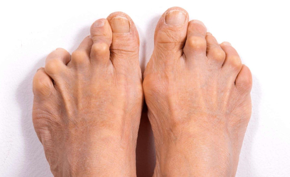 Arthritis Friendly Shoes