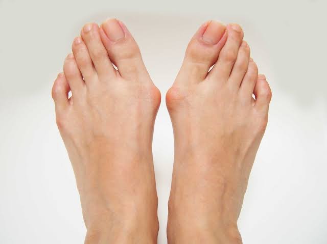 Shoes for Bunions