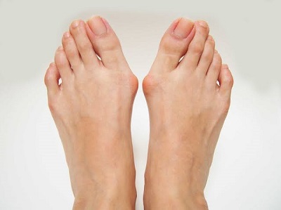 Shoes for Bunions